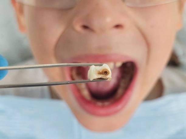 Best Emergency Dental Extractions in Missouri Valley, IA